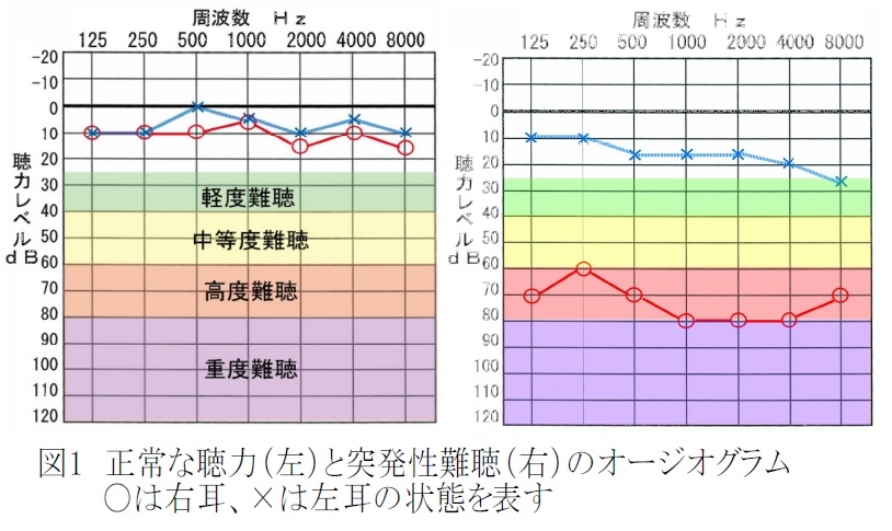 突然 すぐ 治る ない 片耳 聞こえ