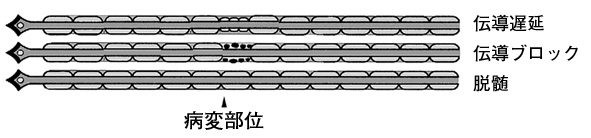 顔面神経障害1