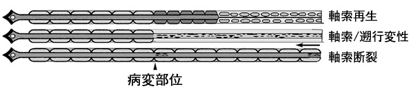 顔面神経障害2