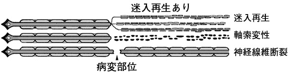 顔面神経障害3