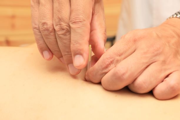 鍼治療は痛くないの？ 